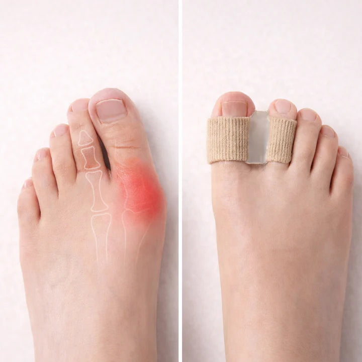 Zehenspreizer bei Hallux Valgus – Schmerzlinderung & Ausrichtung (1 Paar) -    Zorenza